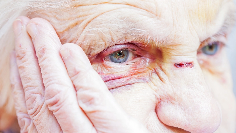 Eine Seniorin hat Schürfwunden im Gesicht